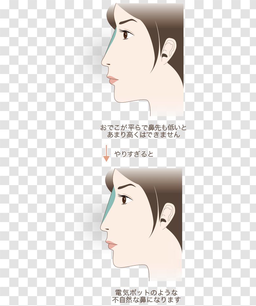 Nose Forehead Eyebrow Hyaluronic Acid 水の森美容外科 - Tree Transparent PNG