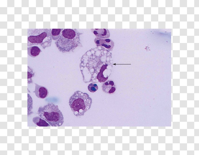 Macrophage Body Fluid Pleural Effusion Hemosiderin - Lilac - Crystal Chandeliers 14 0 2 Transparent PNG