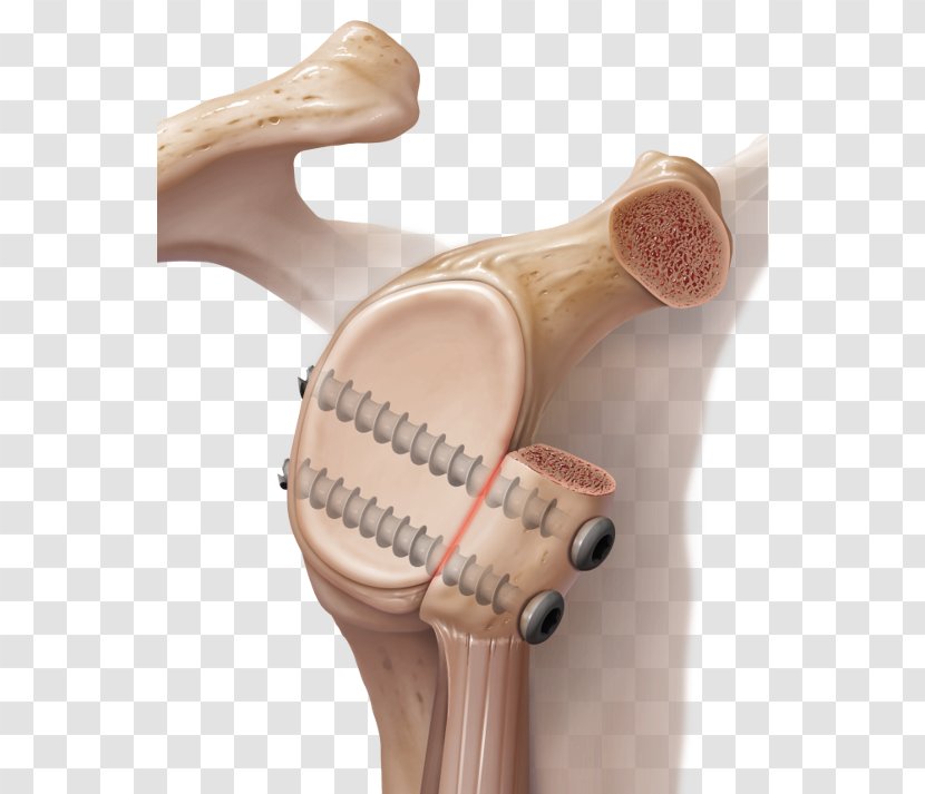 Latarjet Procedure Shoulder Surgery Dislocated Transparent PNG