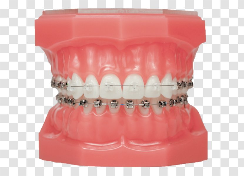 Damon System Dental Braces Clear Aligners Orthodontics Self-ligating Bracket - Selfligating - Invisalign Transparent PNG