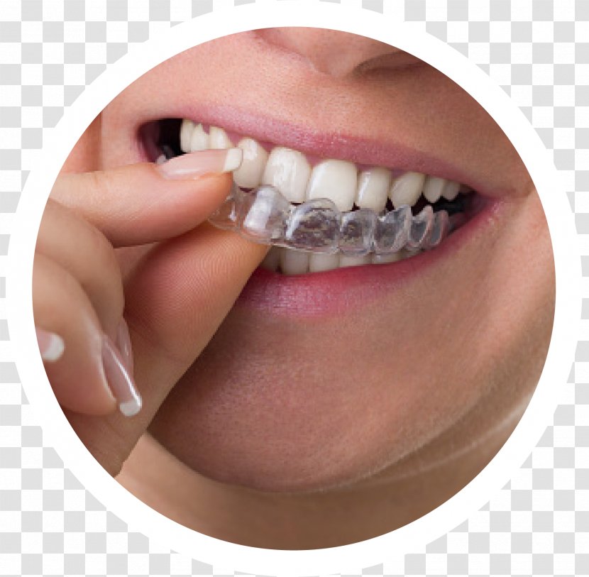 Clear Aligners Dental Braces Dentistry Orthodontics Tooth - Selfligating Bracket Transparent PNG