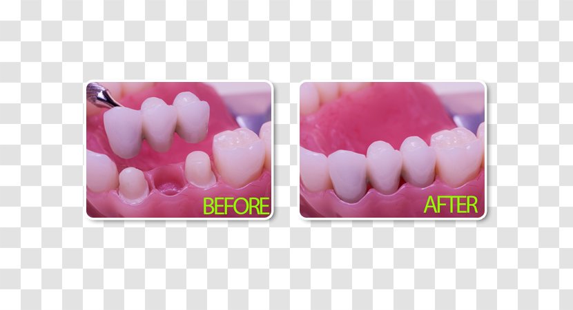 Bridge Dentistry Dental Implant Crown - Mouth Transparent PNG