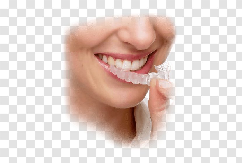 Clear Aligners Orthodontics Dental Braces Dentistry - Cheek Transparent PNG