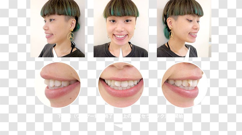 Lip Cheek Mouth Chin Jaw - Eyebrow - Orthodontic Correction Transparent PNG