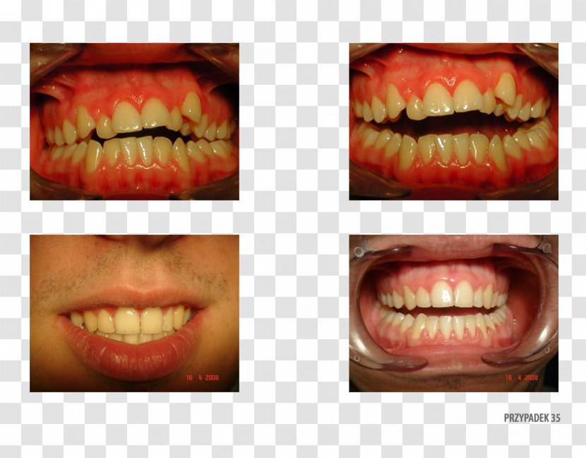 Tooth Gingivoplasty Camera Gums Ortoprotex - Therapy Transparent PNG