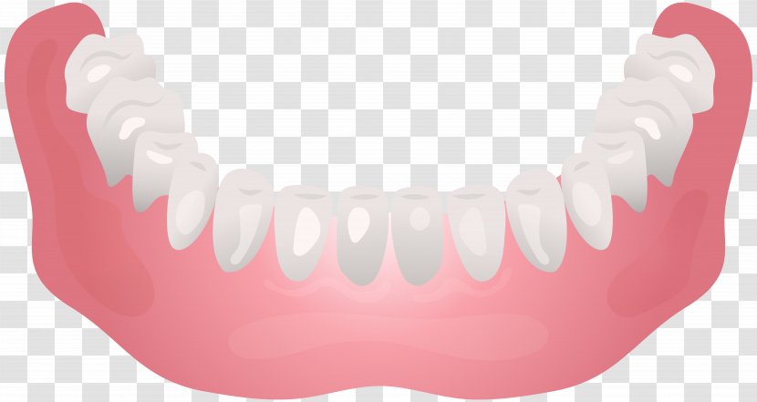 Jaw Mouth Tooth Mandible Clip Art - Implant - Dental Transparent PNG