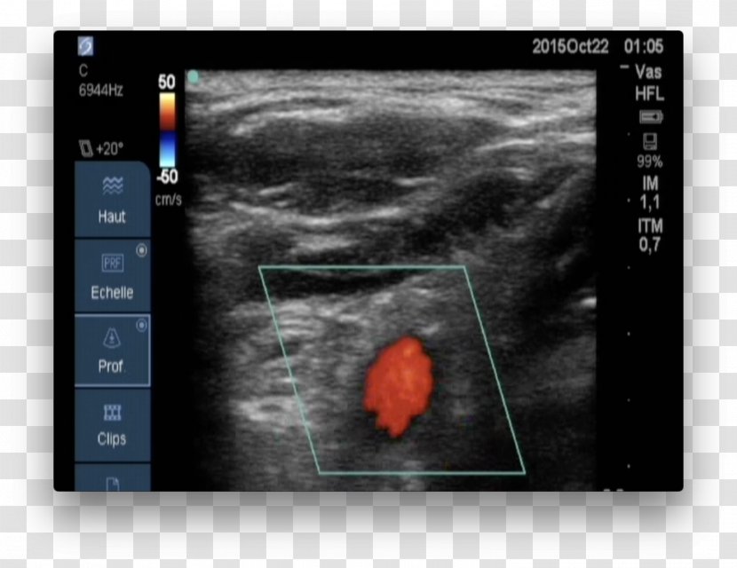 Medical Imaging Magnetic Resonance Screenshot Medicine - Blood Circulation Transparent PNG