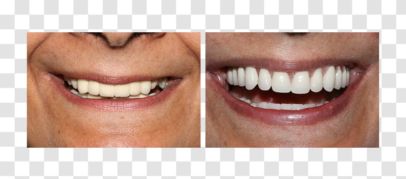 Tooth All-on-4 Dental Implant Dentures - Therapy - Surgery Transparent PNG