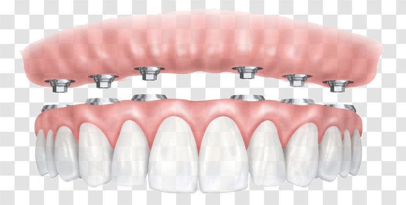 All-on-4 Dental Implant Dentures Dentistry - Sedation Transparent PNG