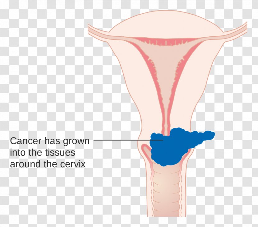 Cervical Cancer Staging Cervix - Heart Transparent PNG