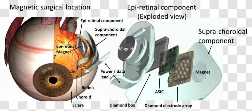 Visual Prosthesis Retinal Implant - Surgery - Eye Transparent PNG