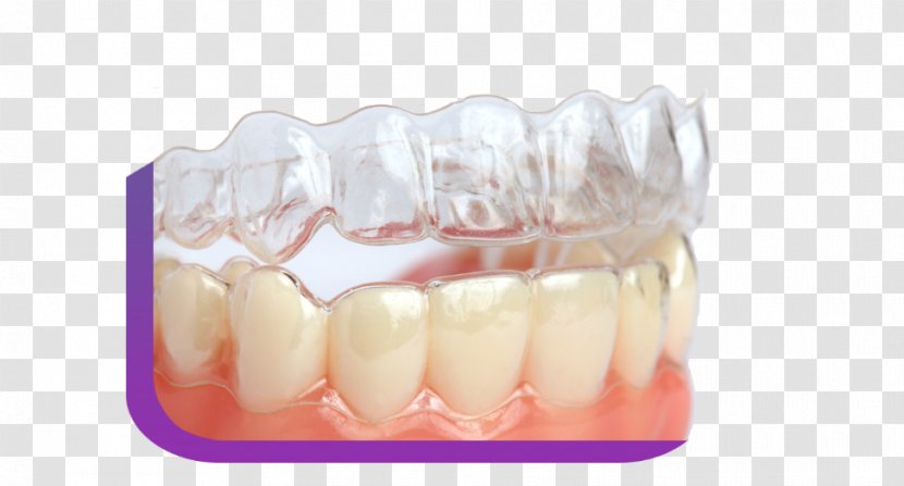 Clear Aligners Dental Braces Dentistry Tooth Orthodontics - Whitening Transparent PNG