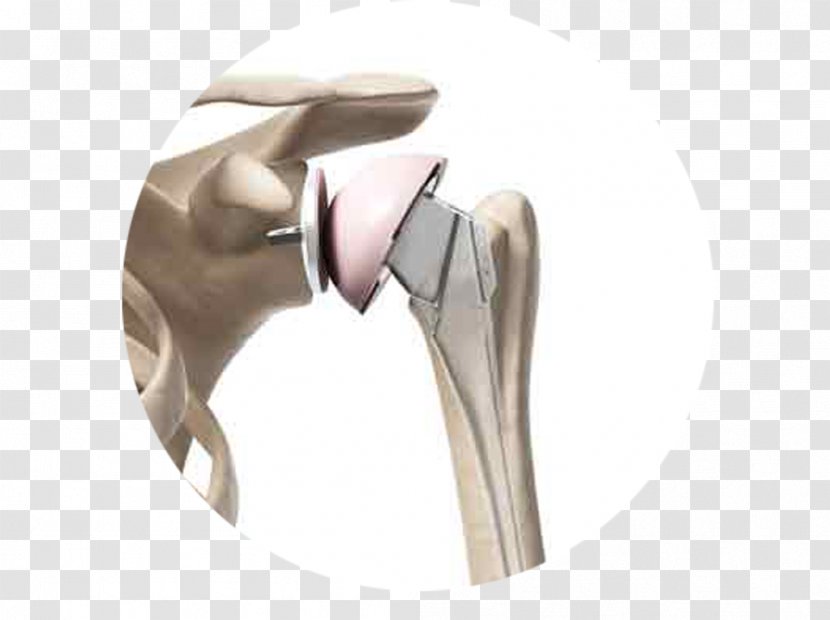 Shoulder Replacement Surgery Joint - Arthroplasty - Rotator Cuff Transparent PNG