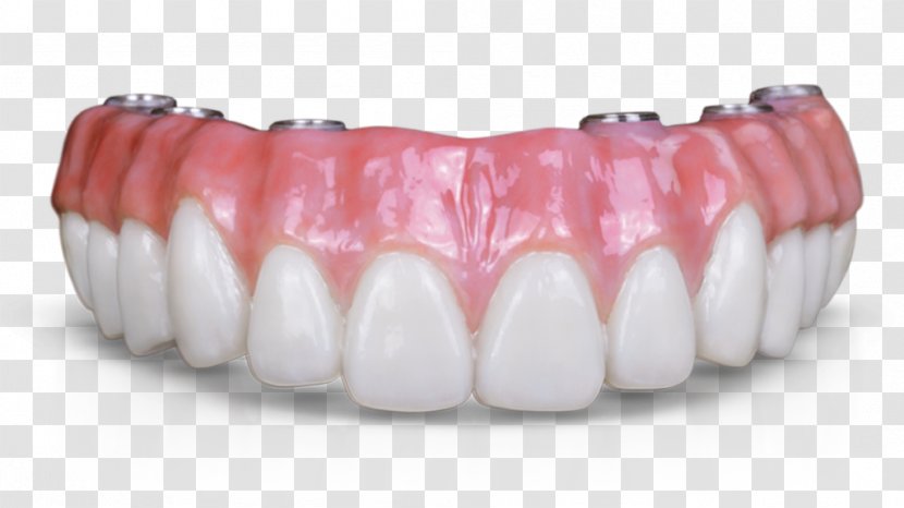 Dental Implant Dentures Dentistry Prosthesis Fixed Prosthodontics - Bridge Transparent PNG