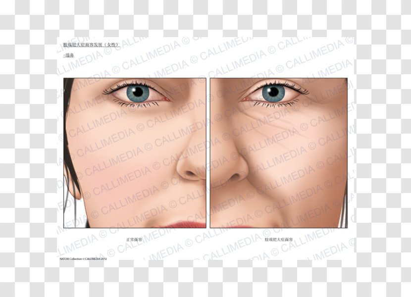 Acromegaly Nose Face Endocrinology Growth Hormone - Close Up Transparent PNG