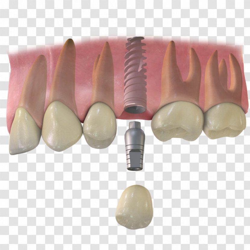 Tooth Dental Implant Dentistry Implantology - Crown - Cabinet Transparent PNG