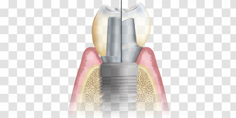 Abutment Dental Implant CAD/CAM Dentistry Implantology - Postcard Transparent PNG