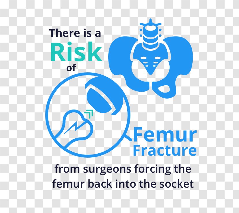 Femur Hip Fracture Femoral Head Bone - Dysplasia Transparent PNG