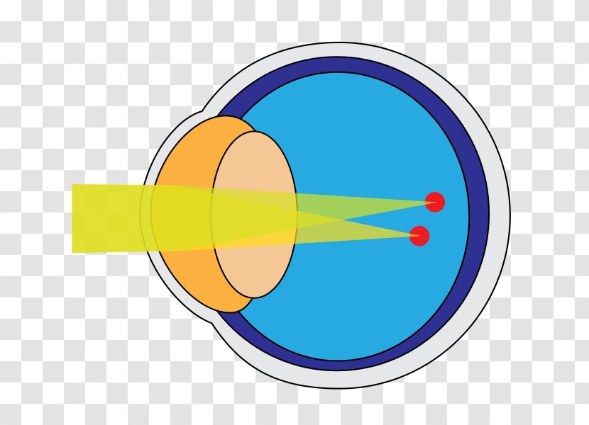 Astigmatism Cornea Eye Disease Near-sightedness Transparent PNG