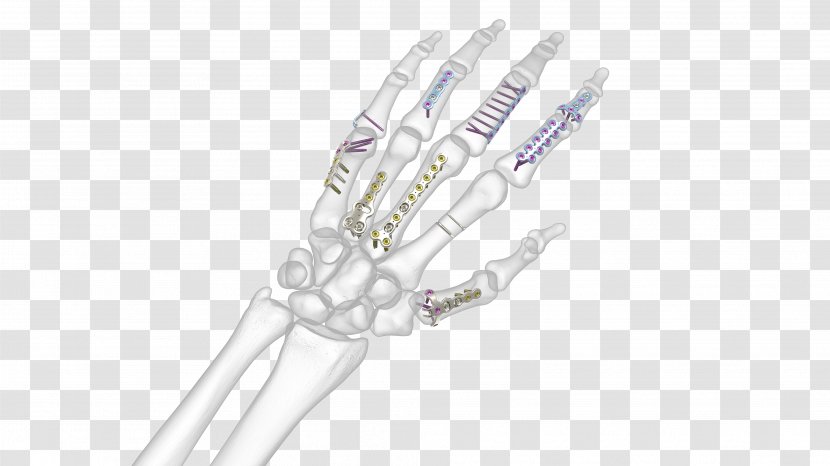 Hand Bone Fracture Synthes Metacarpal Bones Anatomy Transparent PNG