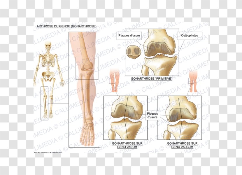 Knee Osteoarthritis Arthritis - Cartoon - Artrosis De Rodilla Transparent PNG