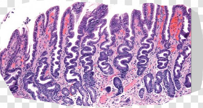 Foveolar Cell Reactive Gastropathy Hyperplasia Pathology - Heart - Tree Transparent PNG