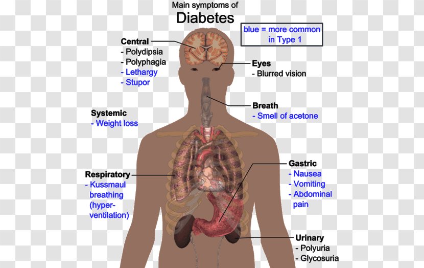 Diabetes Mellitus Type 2 Disease Human Body 1 - Silhouette - According To Dr. Transparent PNG