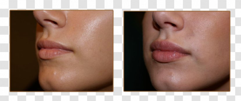 Lip Augmentation Injectable Filler Juvéderm Cheek - Mouth Transparent PNG