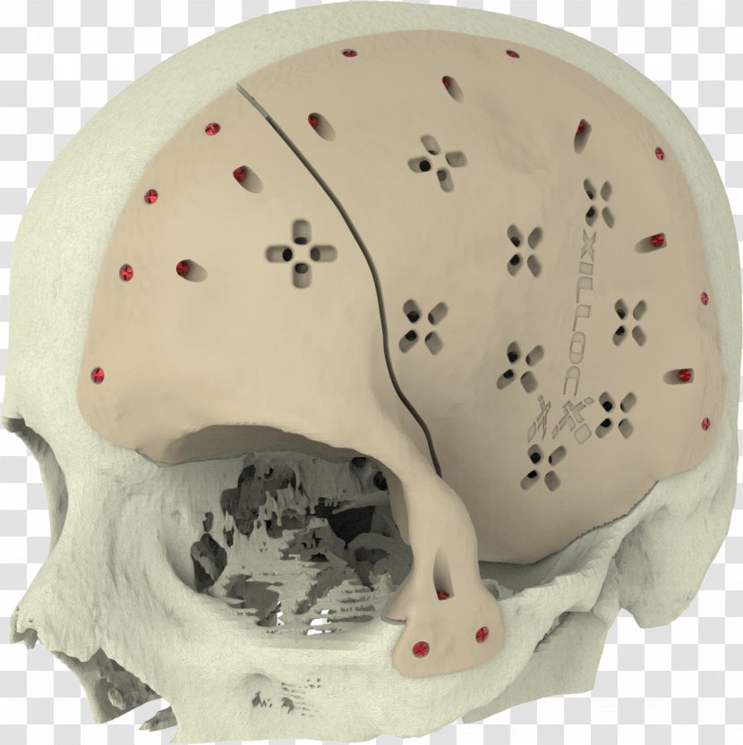 Implant Skull Surgery Knee Replacement Jaw - Therapy - Implants Transparent PNG