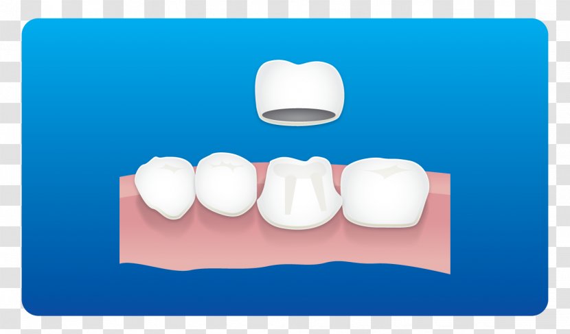 Tooth Dental Implant Root Canal Dentist Restoration - Medical Diagnosis - Clinic Card Transparent PNG