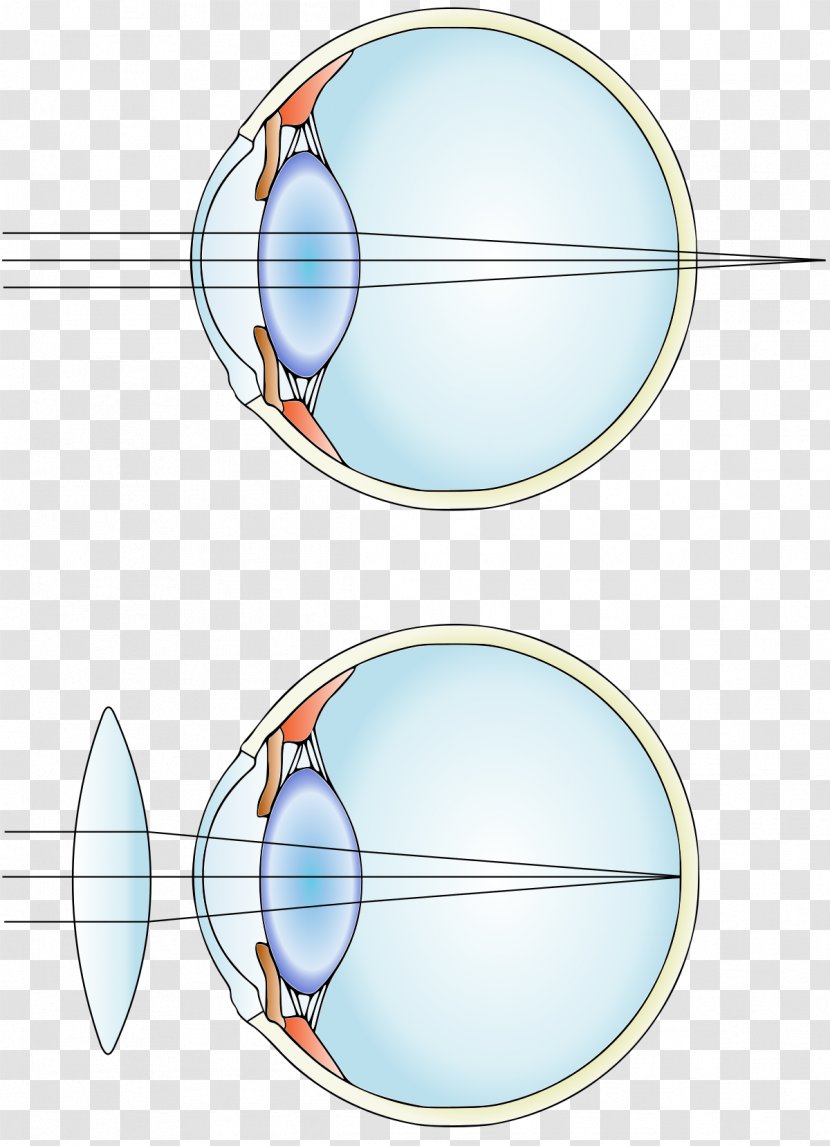 Near-sightedness Hypermetropia Corrective Lens Astigmatism Refractive Surgery - .vision Transparent PNG