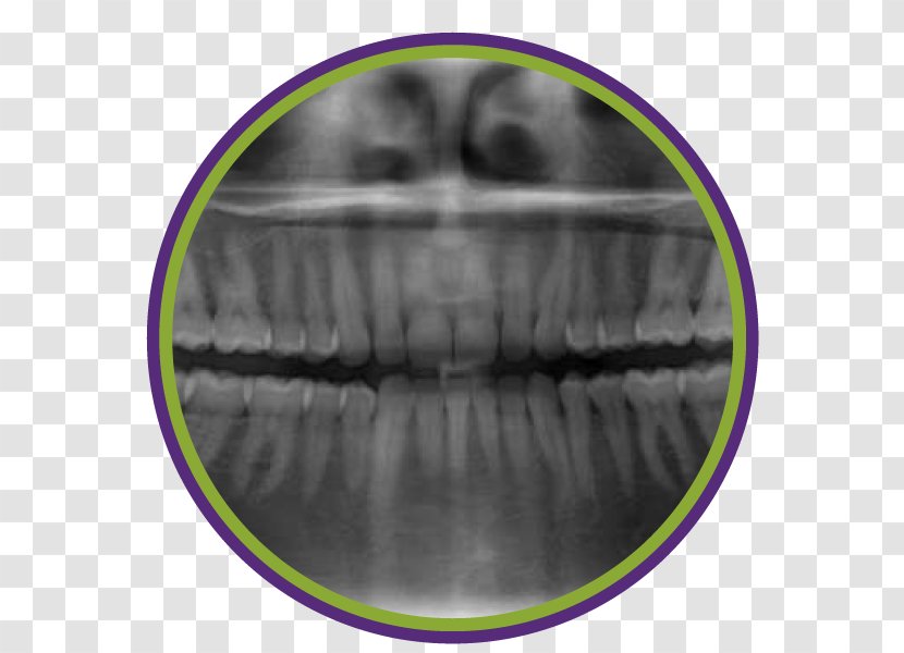 Dentistry Periodontal Disease Tooth Periodontosis Dental Radiography - Cavity Transparent PNG