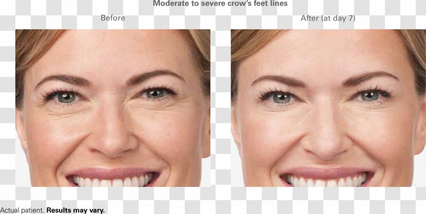 Botulinum Toxin Wrinkle Frown Forehead Injectable Filler - Facial - Hyaluronic Acid Transparent PNG