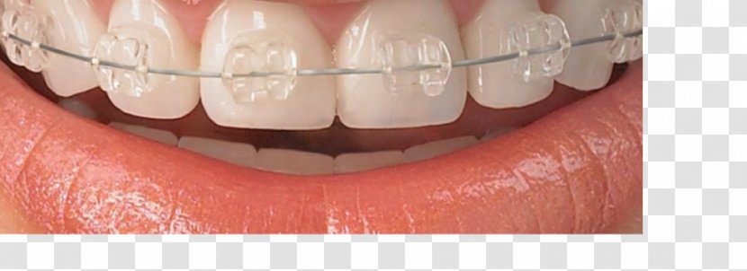 Damon System Weber Orthodontics Dental Braces Dentistry - Cartoon - Dentist Tooth Whitening Transparent PNG