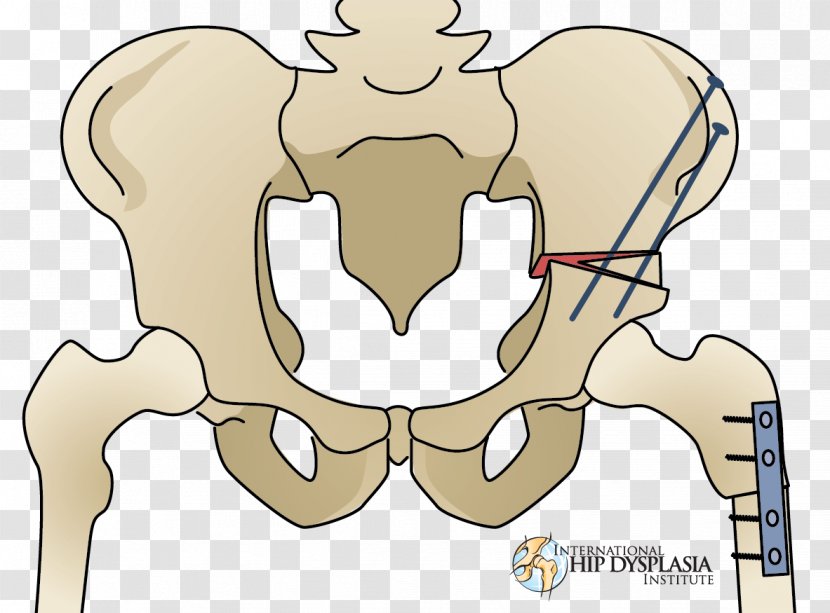 Osteotomy Hip Dysplasia Surgery Therapy - Watercolor - Cicatriz Transparent PNG