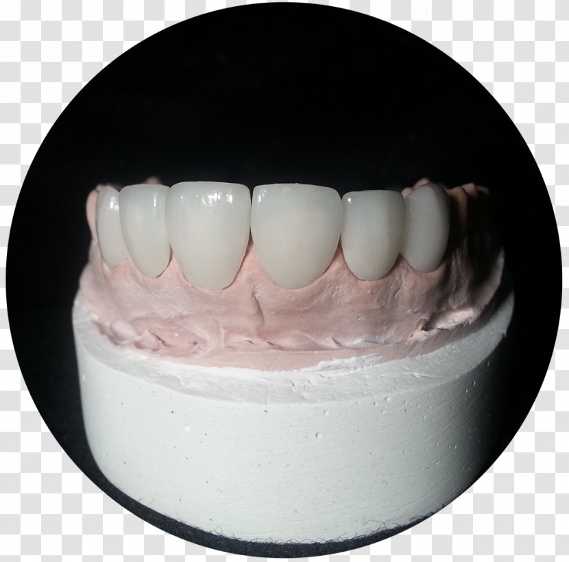 Viax Dental Panamá Glass-ceramic Technology - Jaw - Tooth Crown Transparent PNG
