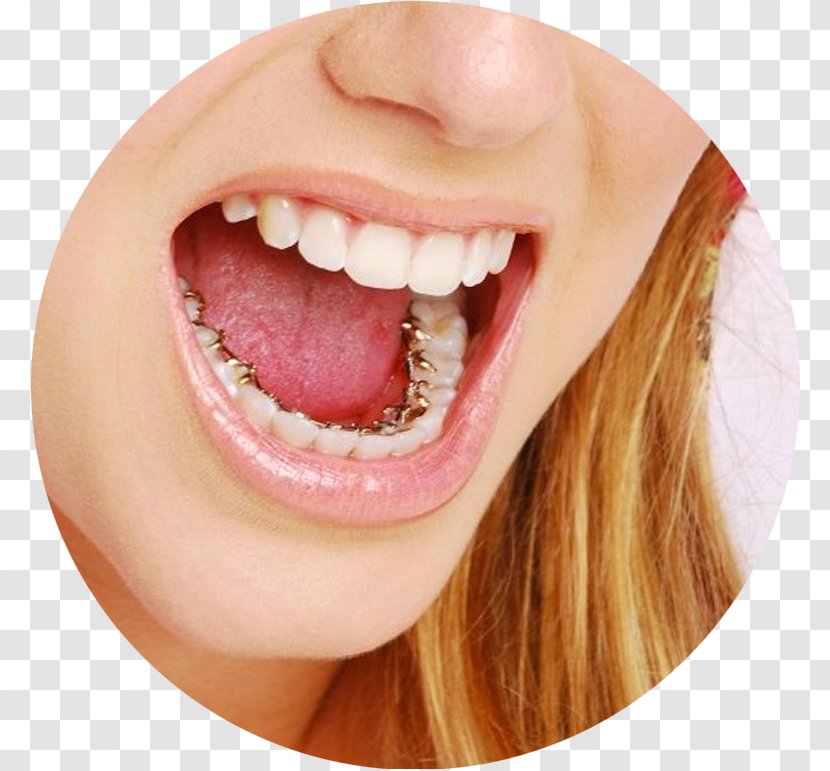 Castleknock Orthodontics Dental Braces Lingual Clear Aligners - Cheek Transparent PNG