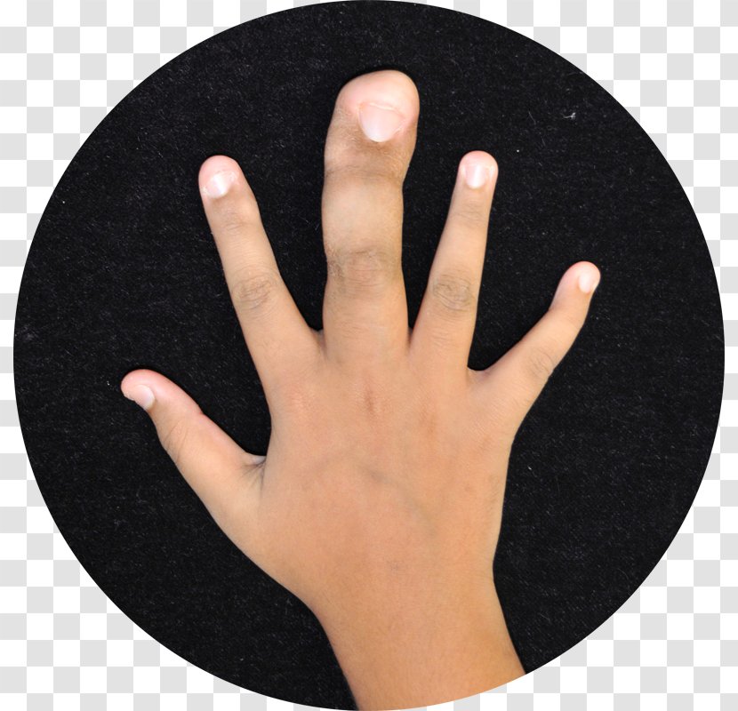 Thumb Finger Local Gigantism Hand Toe - Heart Transparent PNG