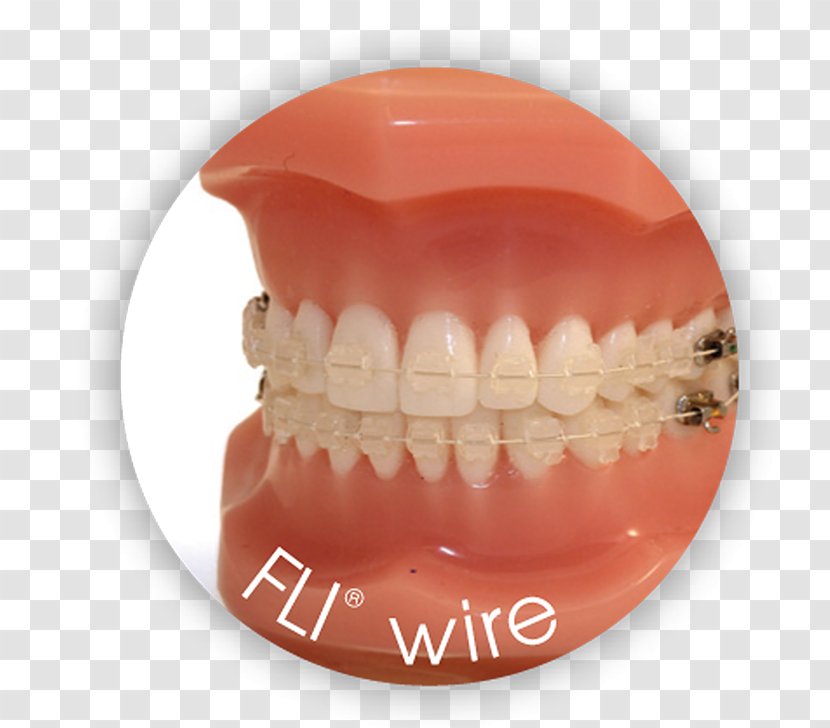 Nickel Titanium Orthodontic Archwire - Alloy - Fli Transparent PNG
