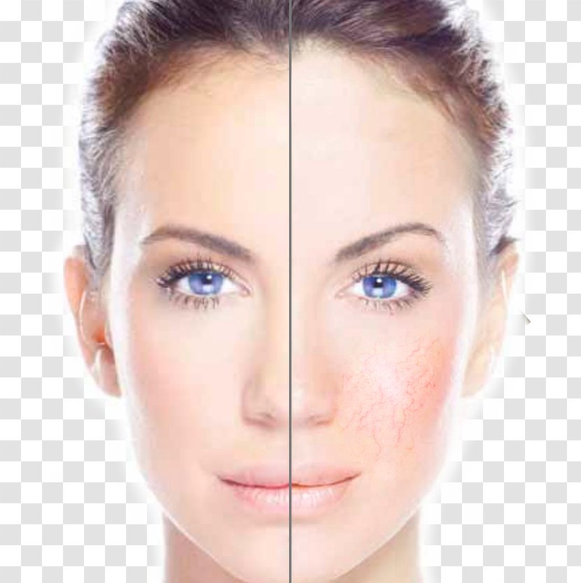 Freckle Laser Hair Removal Hyperpigmentation - Cosmetic Vein Center Transparent PNG