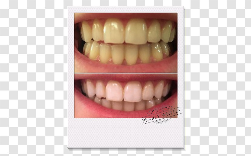 Tooth Whitening Dentistry Human - Smile - Gel Transparent PNG