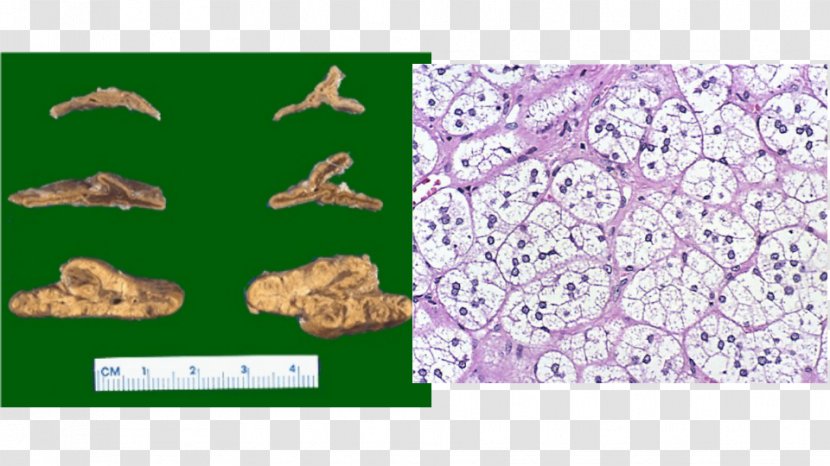 Thyroid Nodule Adrenal Gland Hyperplasia - Follicular Cancer Transparent PNG