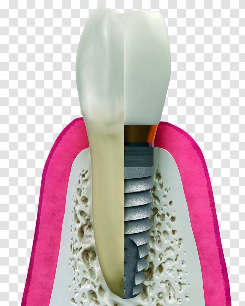 Dental Implant Dentistry Surgery - Implants Transparent PNG