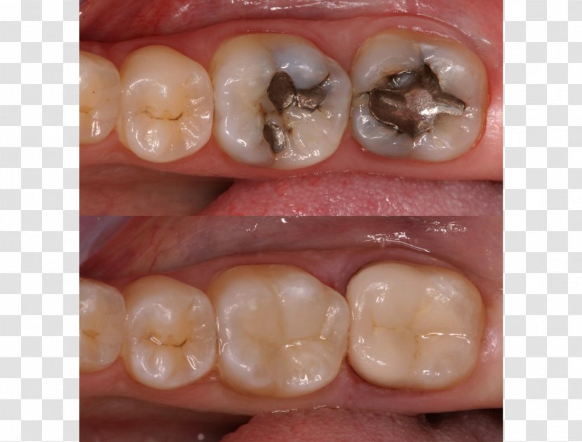 Tooth Dental Restoration Inlays And Onlays Crown Composite - Dentist - Cosmetic Treatment Transparent PNG