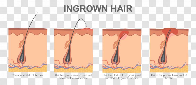 Ingrown Hair Removal Electrolysis Waxing - Follicle - Hairs Transparent PNG