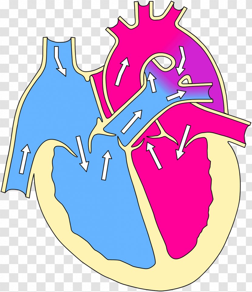 Tetralogy Of Fallot Ventricular Septal Defect Congenital Heart Patent Ductus Arteriosus - Cartoon - Attack Transparent PNG
