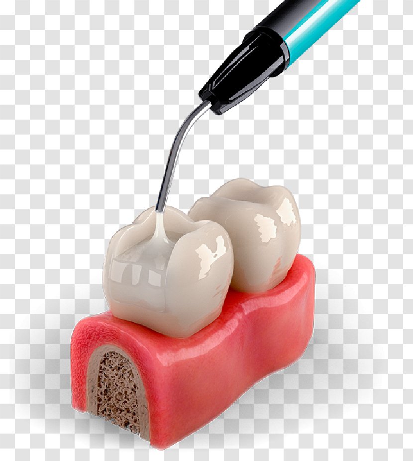 Tooth Decay Dentistry Neck - Dental Material Transparent PNG