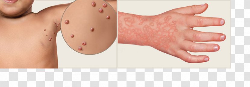 Exanthem Skin Rash Virus Morbilliform Fifth Disease - Watercolor - Child Transparent PNG