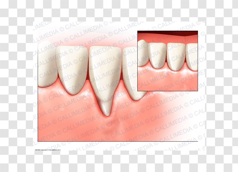 Tooth Gums Surgery Periodontal Disease Gingival Recession - Health Transparent PNG