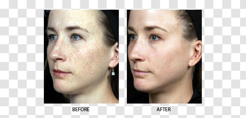 Fraxel Photorejuvenation Laser Dermatology Hair Removal - Cheek - Skin Transparent PNG